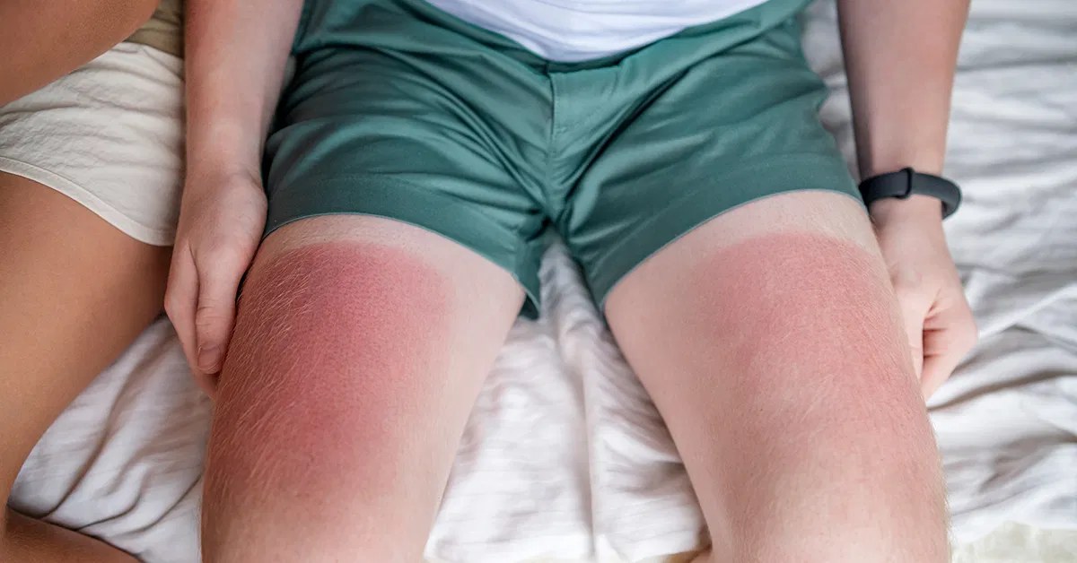 How to Soothe Sunburned Skin Safely